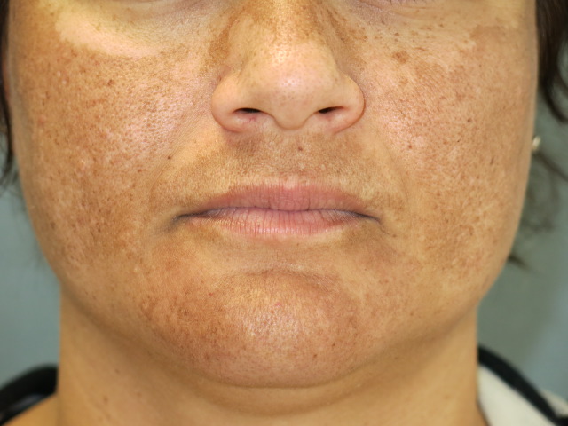O melasma ocorre mais frequentemente no rosto, podendo aparecer também nos braços e na parte da frente do tórax.